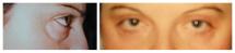 Blepharoplasty - Eye Lids and Eye Bags Plastic Surgery photo