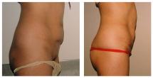 Mini Tummy Tuck - before and 2 weeks after