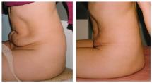 Mini Tummy Tuck - before and 2 weeks after