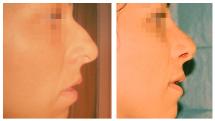 Rhinoplasty before and after photos