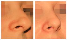 Rhinoplasty before and after photos