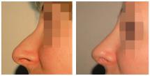 Rhinoplasty before and after photos