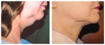 Chin Liposuction - photo Before & After