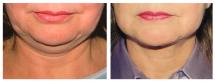 Chin Liposuction - photo Before & After