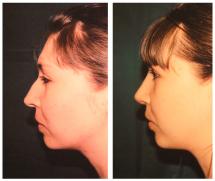 Rhinoplasty before and after photos