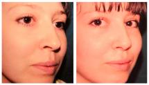 Rhinoplasty before and after photos