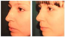 Rhinoplasty before and after photos