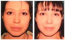 Rhinoplasty photos before and after