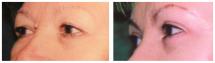 Blepharoplasty - Eye Lids and Eye Bags Plastic Surgery photo