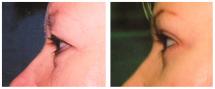 Blepharoplasty - Eye Lids and Eye Bags Plastic Surgery photo