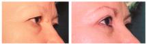 Blepharoplasty - Eye Lids and Eye Bags Plastic Surgery photo