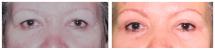 Blepharoplasty - Eye Lids and Eye Bags Plastic Surgery photo