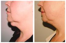 Chin Liposuction - photo Before & After