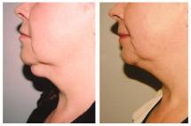 Lipoma removal - photo before and after 