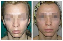 Face lift before and after photos
