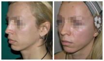 Ανόρθωση προσώπου φωτογραφίες Facelift - Πριν και Μετά