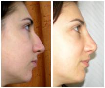 Rhinoplasty before and after photos