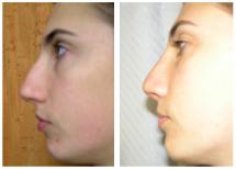 Rhinoplasty before and after photos