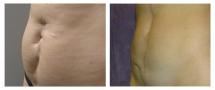 Removal of postoperative scar on abdomen - photo before and after