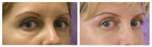 Blepharoplasty - Eye Lids and Eye Bags Plastic Surgery photo