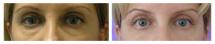 Blepharoplasty - Eye Lids and Eye Bags Plastic Surgery photo