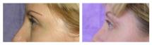 Blepharoplasty - Eye Lids and Eye Bags Plastic Surgery photo