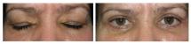 Blepharoplasty and xanthelasma - Eye Lids and Eye Bags Plastic Surgery photo