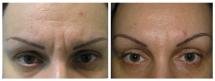 Botox photos - Before and After