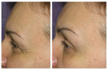 Botox photos - Before and After