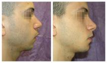Genioplasty with chin silicone implant. Photos before and after 1 month.