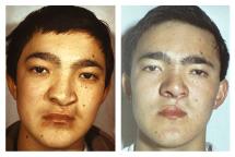 secondary rhinoplasty and cheiloplasty cleft upper lip Reconstructive Surgery