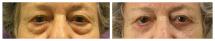 Blepharoplasty - Eye Lids and Eye Bags Plastic Surgery photo