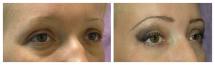 Blepharoplasty - Eye Lids and Eye Bags Plastic Surgery photo