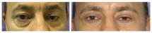 Blepharoplasty - Eye Lids and Eye Bags Plastic Surgery photo