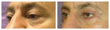 Blepharoplasty - Eye Lids and Eye Bags Plastic Surgery photo