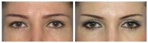 Blepharoplasty - Eye Lids and Eye Bags Plastic Surgery photo