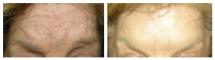 Botox photos - Before and After