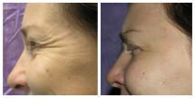 Botox photos - Before and After