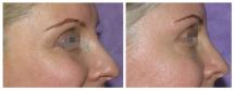 BOTOX φωτογραφίες - Πριν και Μετά