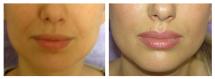 Restylane injections - Nasolabial folds - before and after