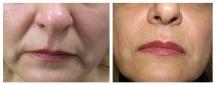 Restylane injections - Nasolabial folds - before and after