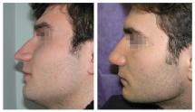 Rhinoplasty photos before and after