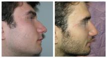 Rhinoplasty photos before and after