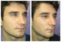 Rhinoplasty photos before and after