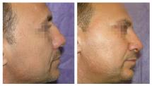 Rhinoplasty photos before and after