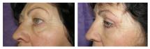 Blepharoplasty - Eye Lids and Eye Bags Plastic Surgery photo