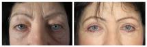 Blepharoplasty - Eye Lids and Eye Bags Plastic Surgery photo