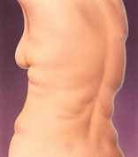 Liposuction and Liposculpture - Before and After